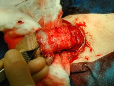 Intraoperative findings: the focus of bleeding from ruptured site of