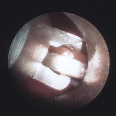 Endoscopic view of a nickel and penny in the esoph