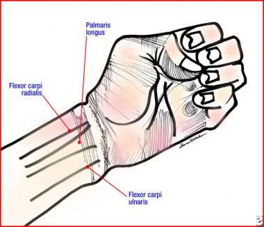 Soft Tissue Injuries of the Hand: Practice Essentials, Pathophysiology