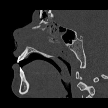 Sagittal CT scan demonstrating frontal sinus floor