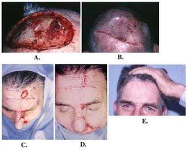 Advancement flaps. A: Mohs defect over the scalp v