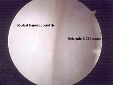 Arthroscopic view of osteochondritis dissecans of 