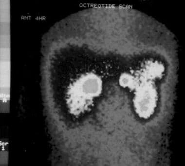 Somatostatin receptor scintigraphy in a young pati