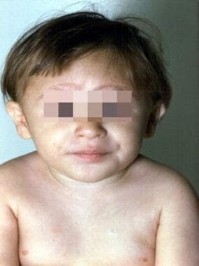 The 3-year-old patient with Fanconi anemia seen in