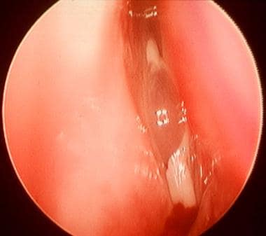 Endoscopic view of the left nasal cavity posterior