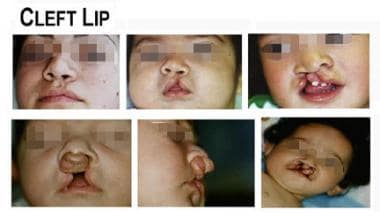 Examples of cleft lip. 