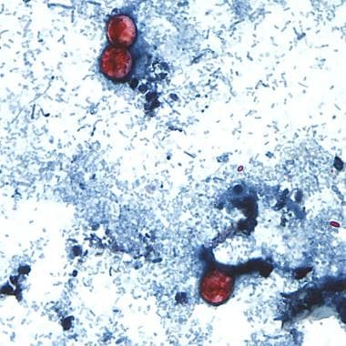 This photomicrograph of a fresh stool sample, whic
