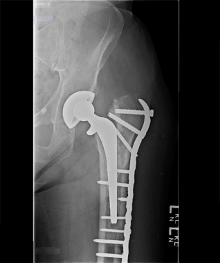 Vancouver B1 fracture treated with locked plating 
