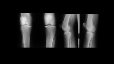 Growth plate (physeal) fractures. Comparison radio
