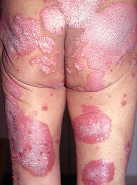 Plaque psoriasis. Courtesy of University of Britis