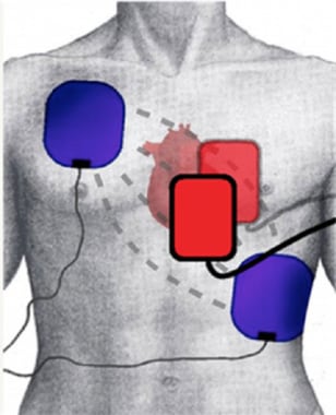 pads cardioversion paddles anteroposterior position synchronized electrical anatomic placements common anterolateral represent blue red