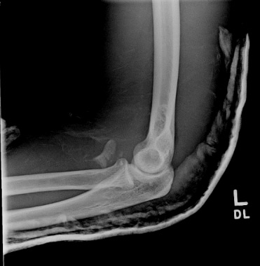 Type 3 coronoid fracture: fracture involving >50% 