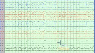 Ictal EEG recording of right temporal lobe epileps