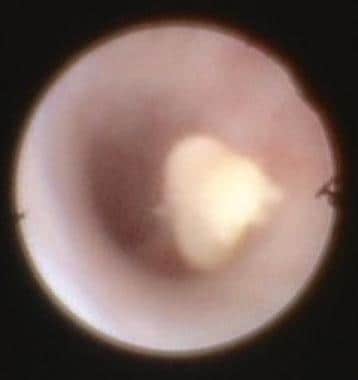 Shown is 3-mm free-floating stone within submandib