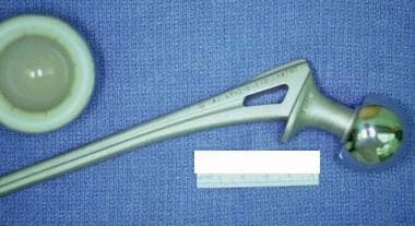 A hip prosthesis removed at autopsy. 