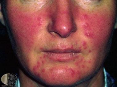 Severe erythema, papules, and pustules. Courtesy o