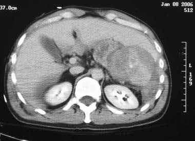 CT scan of abdomen demonstrating large delayed rup