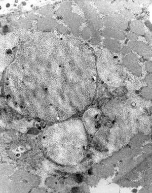 Electron micrograph in Type II glycogenosis, acid 