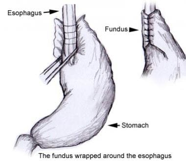 Laparoscopic Nissen Fundoplication Technique: Laparoscopic Nissen ...