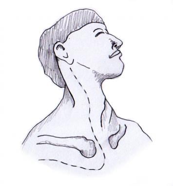 Anterior approach to Pancoast tumor. Neck incision
