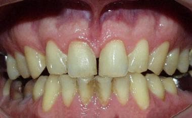 Moderate chronic gingivitis. Note that the papilla
