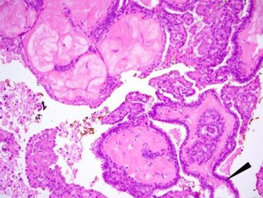 Intraductalis papilloma vs csatorna ectasia, Phylloid tumor