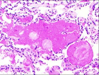 Pulmonary alveolar proteinosis. Intra-alveolar mat