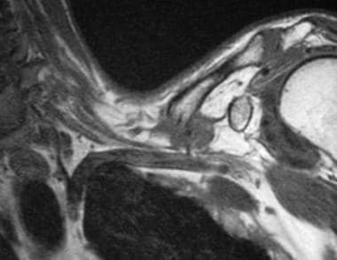 Clavicular fracture in a 57-year-old man with a tr
