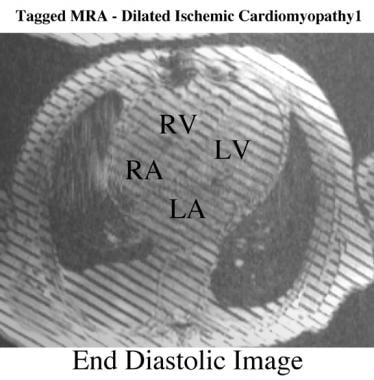 Oblique axial end-diastolic breath-hold linear-tag