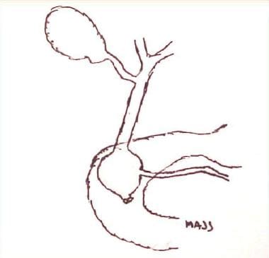 Type III choledochal cyst. 