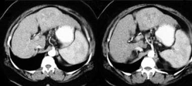 CT scan in the hepatic arterial phase of contrast 