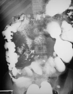 Sprue. Radiograph from a small-bowel series in a p