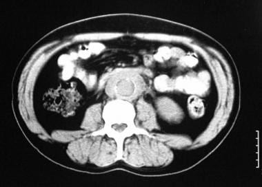 Nonenhanced transaxial CT scan of the abdomen in a