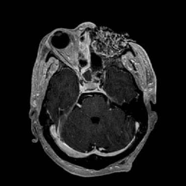 MRI (1.5 Tesla) of the same patient (56-year-old w
