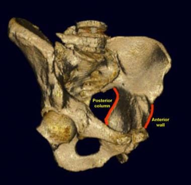 Left iliac oblique view of the pelvis. The left il