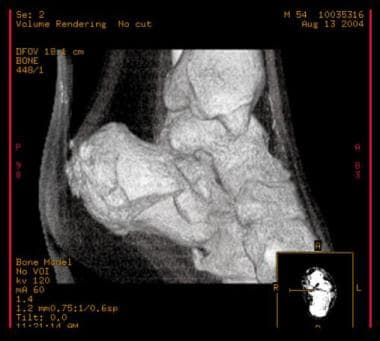 Calcaneus, fractures. CT scan. 