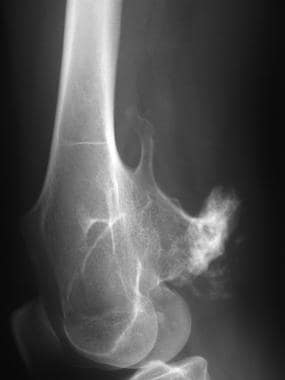 Lateral radiograph of the distal femur in a patien