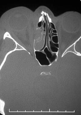 Nasal fracture. Axial CT scan shows a nasal fractu