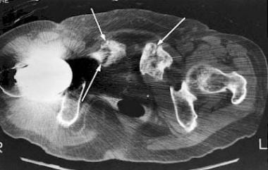Axial CT of the pubis reveals insufficiency fractu