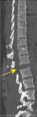 Thoracic spine trauma. Sagittal CT scan of the tho