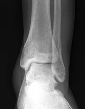 Anteroposterior radiograph from a 22-year-old man 