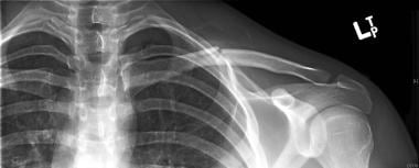 Type 1 clavicular fracture (middle third). 