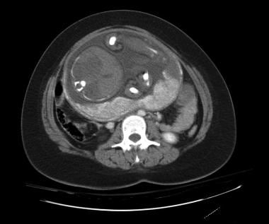 Placental ischemia: Contrast-enhanced CT image dem