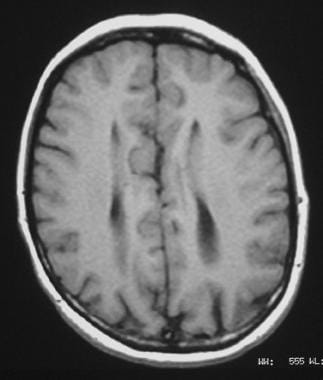 Corpus callosum, agenesis. Axial T1-weighted MRI s