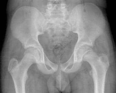Slipped capital femoral epiphysis. Image in a 14-y