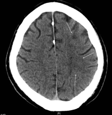 Carotid artery, stenosis. Axial CT of the brain in