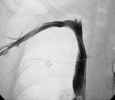 Thoracic outlet syndrome. A venogram obtained in a