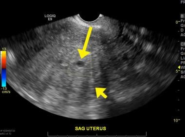 Transvaginal sagittal image of the uterus showing 