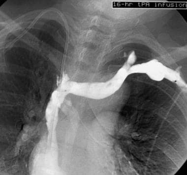 This image follows a 16-hour catheter-directed thr