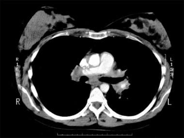 Stage II sarcoidosis. Courtesy of Anthony Notino, 